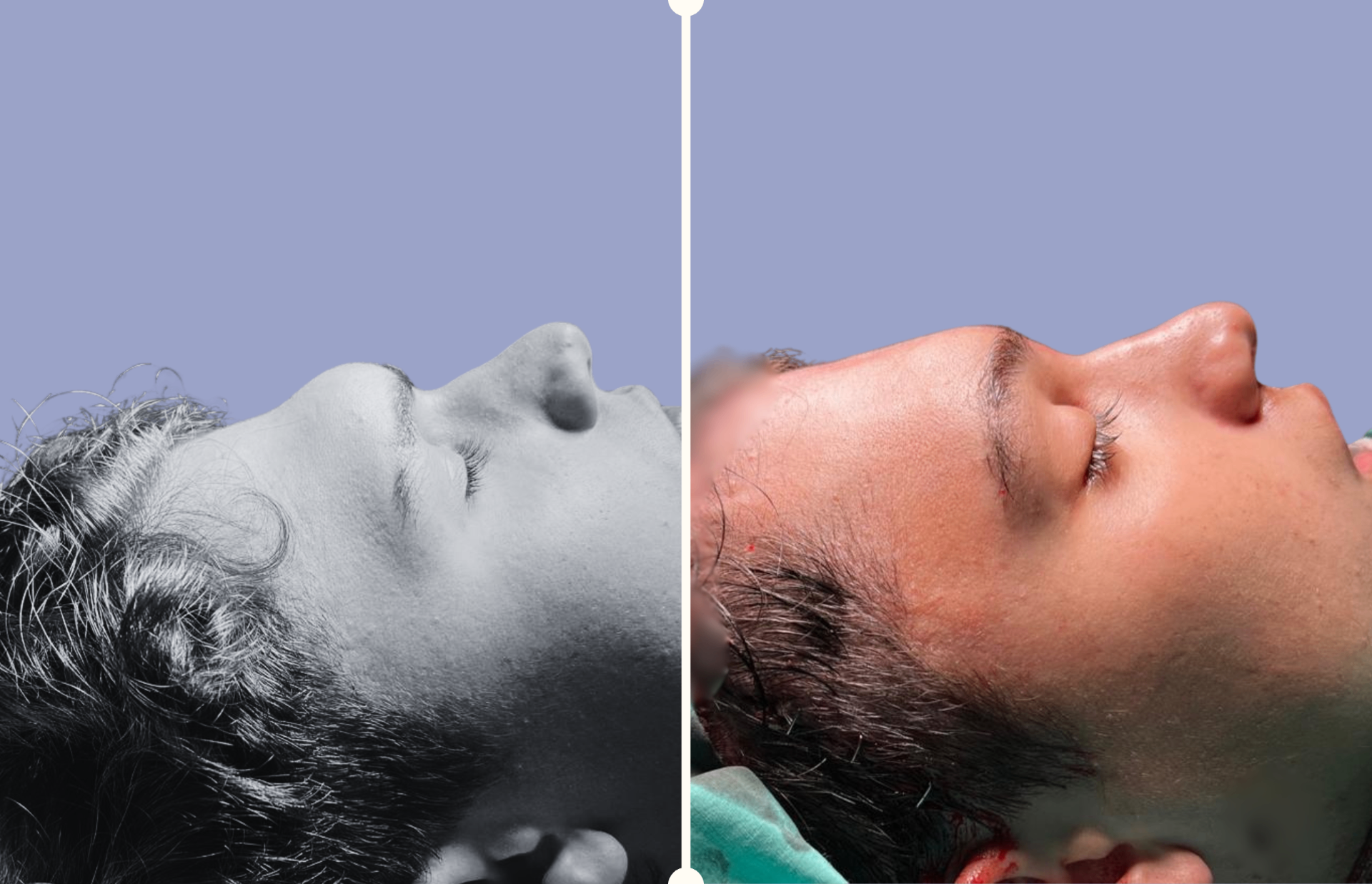 Cirugía Estética Ósea Facial