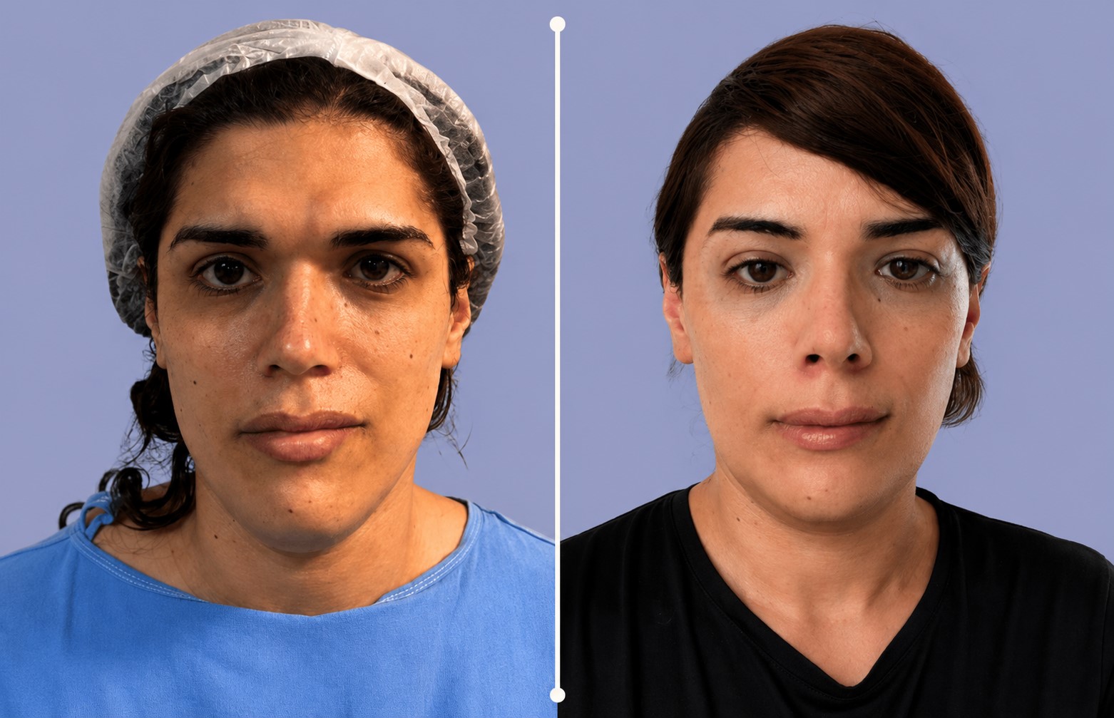 Feminización Facial