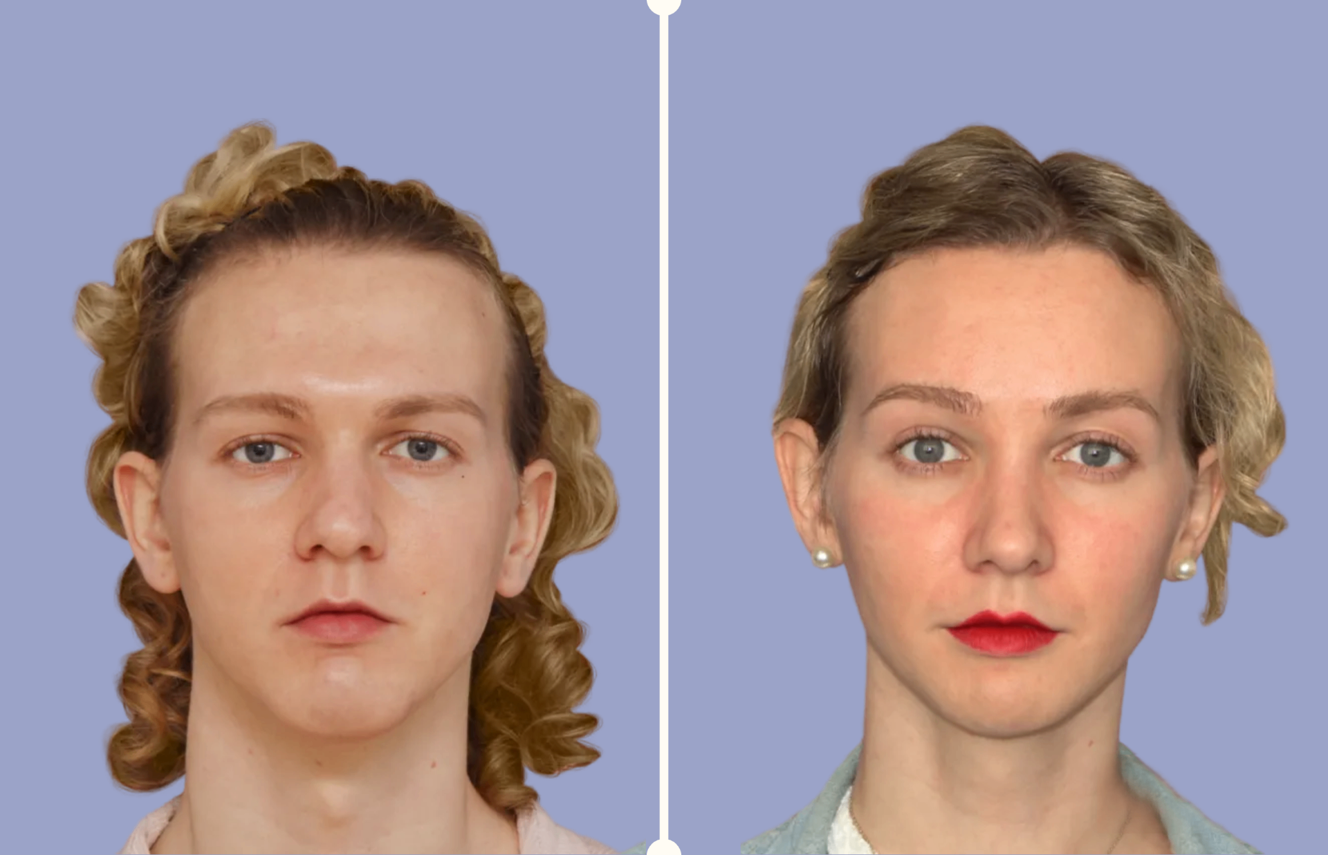 Feminización Facial