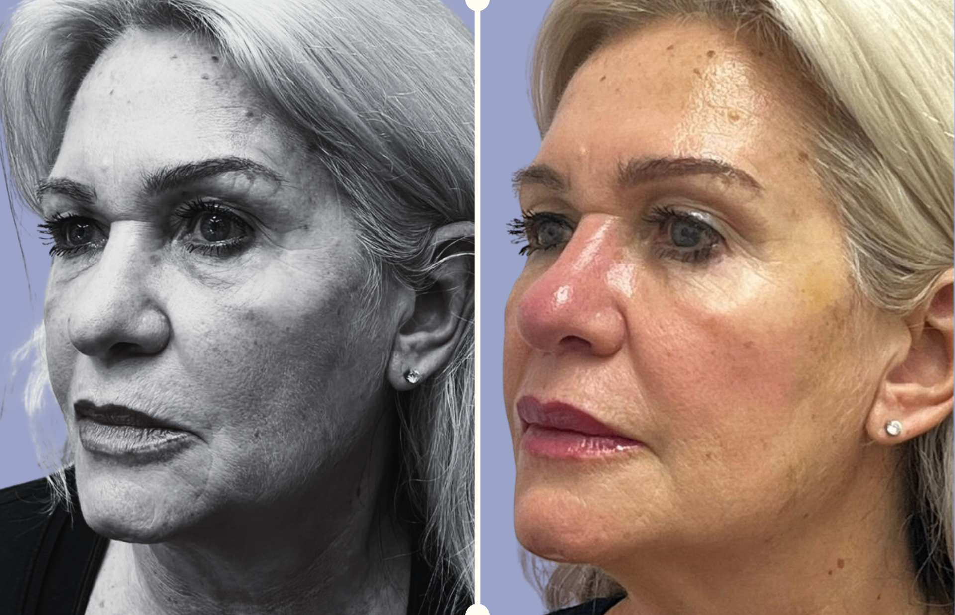 Rejuvenecimiento Facial